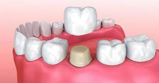 Loose Crown Problem Chat, Discussing Loose Crowns Blog online.  Loose Crowns Problems Discussion and Dental Crown Problem Chat